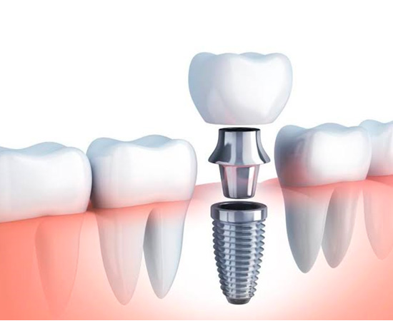 Foto Tratamento Implantes Dentários - Dra Juliana Montes - Odontologia