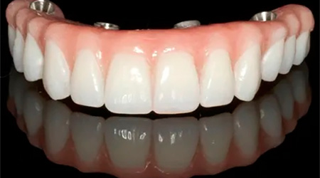 Foto Tratamento Próteses Dentárias - Odontologia Koza