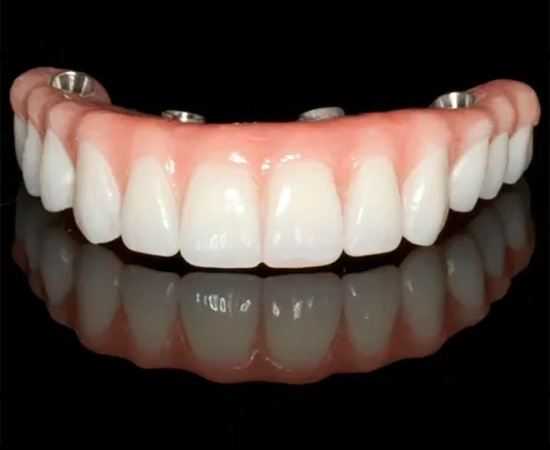 Foto Tratamento Proteses Dentárias - Dra Juliana Montes - Odontologia