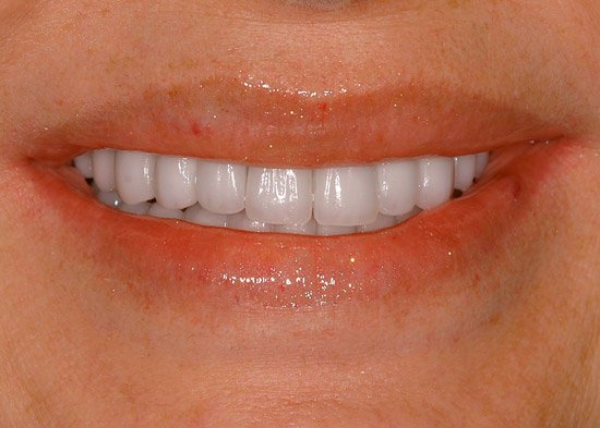 Foto Tratamento Reabilitações - Odontologia Koza