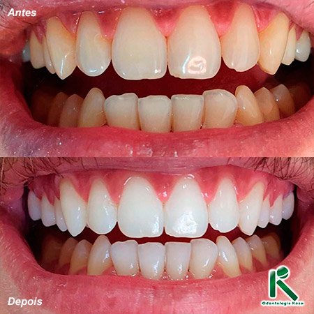 Clínica Geral - Clareamento - Odontologia Koza