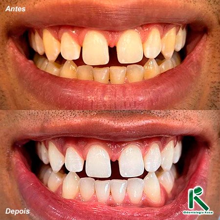 Clínica Geral - Clareamento - Odontologia Koza