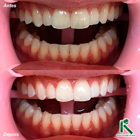 Clínica Geral - Clareamento - Odontologia Koza