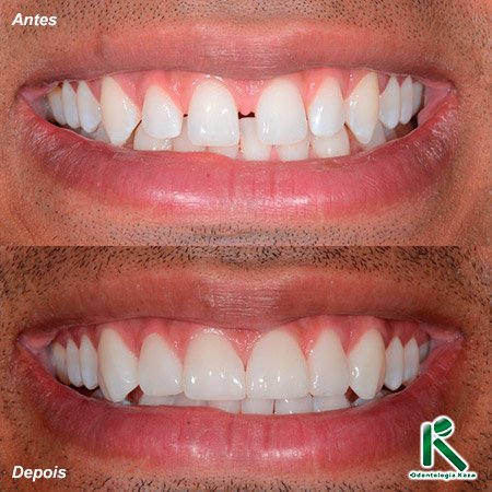 Facetas e Lentes de Contato Dental - Odontologia Koza
