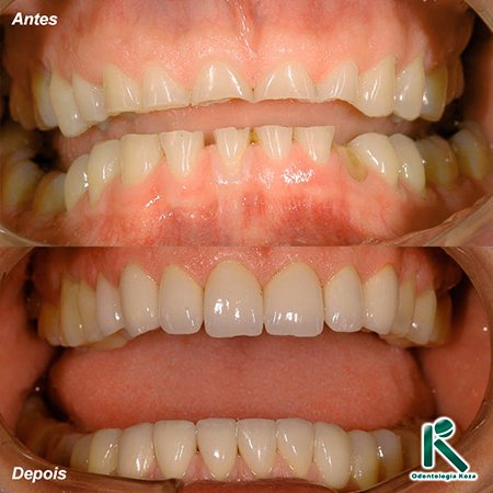 Facetas e Lentes de Contato Dental Odontologia Koza