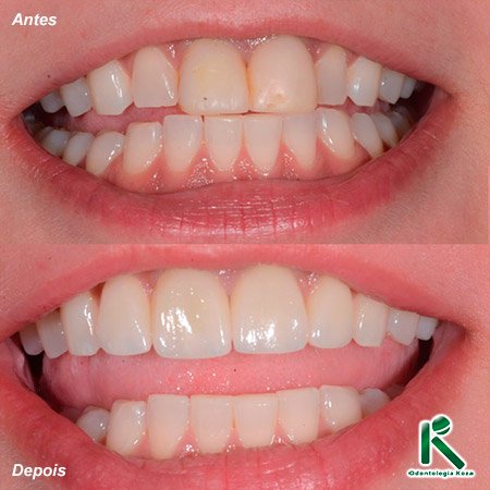 Facetas e Lentes de Contato Dental Odontologia Koza