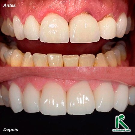 Facetas e Lentes de Contato Dental Odontologia Koza