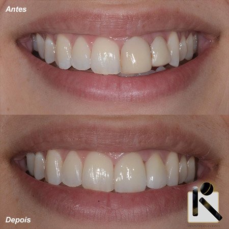 Facetas e Lentes de Contato Dental Odontologia Koza