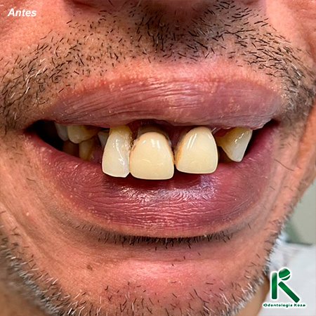 Proteses Dentárias - Odontologia Koza
