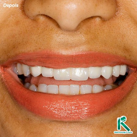 Proteses Dentárias - Odontologia Koza