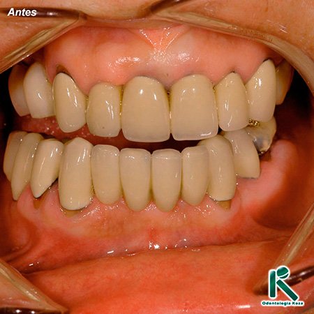 Reabilitação Dental - Odontologia Koza