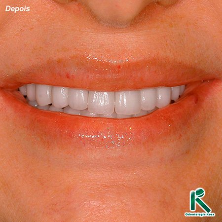 Reabilitação Dental - Odontologia Koza