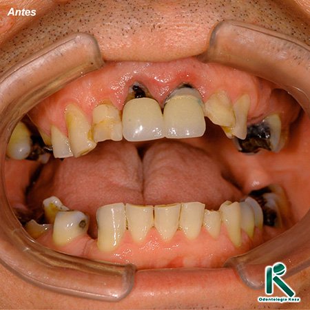 Reabilitação Dental - Odontologia Koza